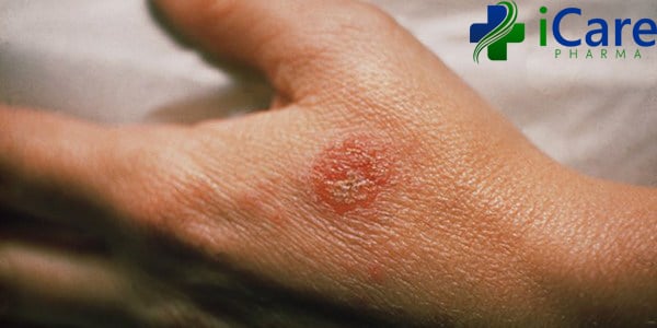 Nguyên nhân và triệu chứng của bệnh Eczema - căn bệnh viêm da không thể coi thường - iCare Pharma