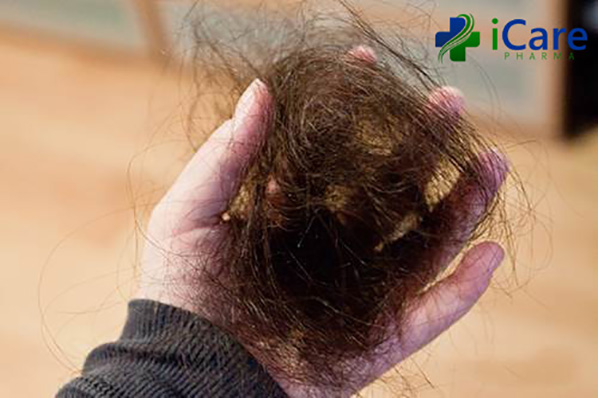 Nguyên nhân rụng tóc và quá trình phục hồi sau Telogen Effluvium là gì   Yhocvnnet Y học Bạch Mai