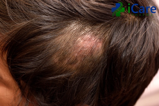 scalp infection image