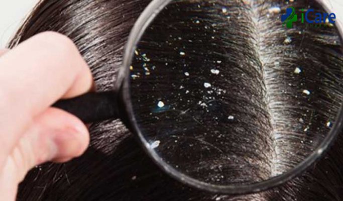Bị nấm tóc phải làm sao? 5 cách điều trị tận gốc nhanh chóng tại nhà