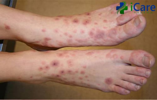 eczema cu simptome varicoase