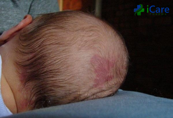 Những lưu ý khi điều trị nấm da đầu cho trẻ nhỏ - iCare Pharma