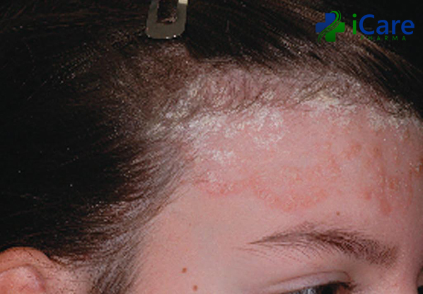 Quá trình điều trị bệnh eczema kéo dài bao lâu và cần sự theo dõi y tế thường xuyên không?