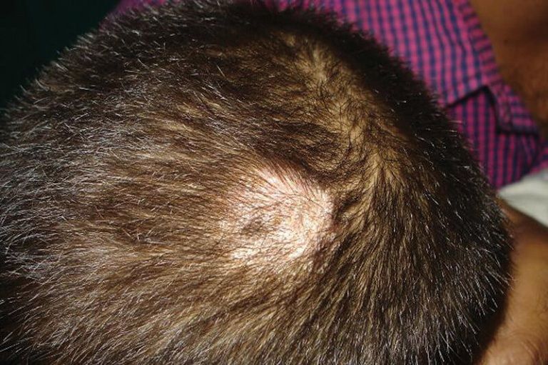 Chân tóc có mụn mủ là bệnh gì?