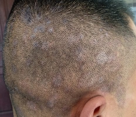 CHIA SẺ Nguyên nhân gây rụng tóc ở nam giới