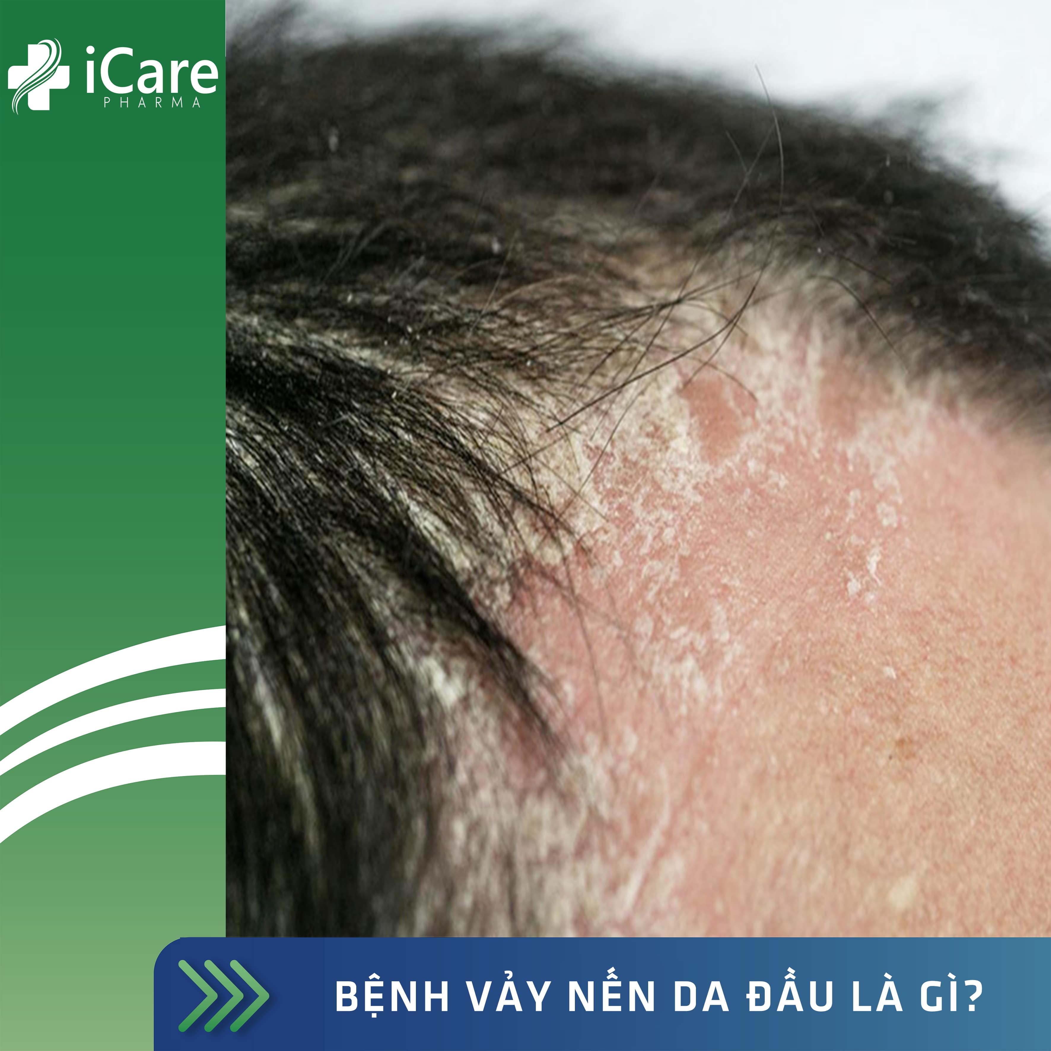 Bệnh vẩy nến da đầu là gì?  Dấu Hiệu Vẩy nến da đầu và cách điều trị hiệu quả - iCare Pharma