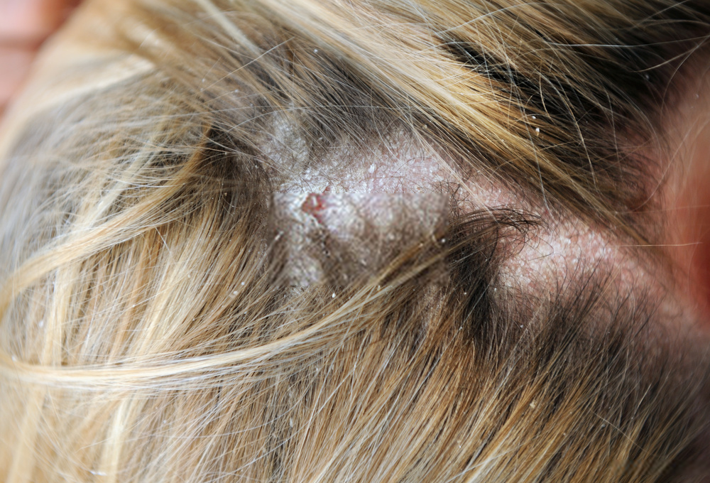 Nấm da đầu có nguy hiểm không? Nguyên nhân và cách chữa trị - iCare Pharma