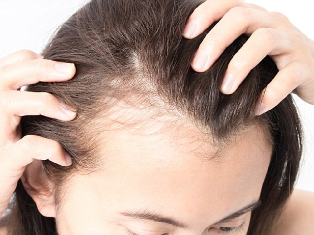 Chuẩn đoán một số bệnh lý rụng tóc thường gặp nhất hiện nay