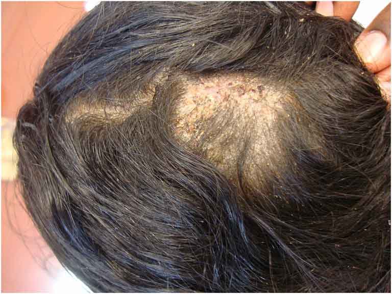 Nấm da đầu  Nấm tóc Nguyên nhân và cách điều trị tại nhà