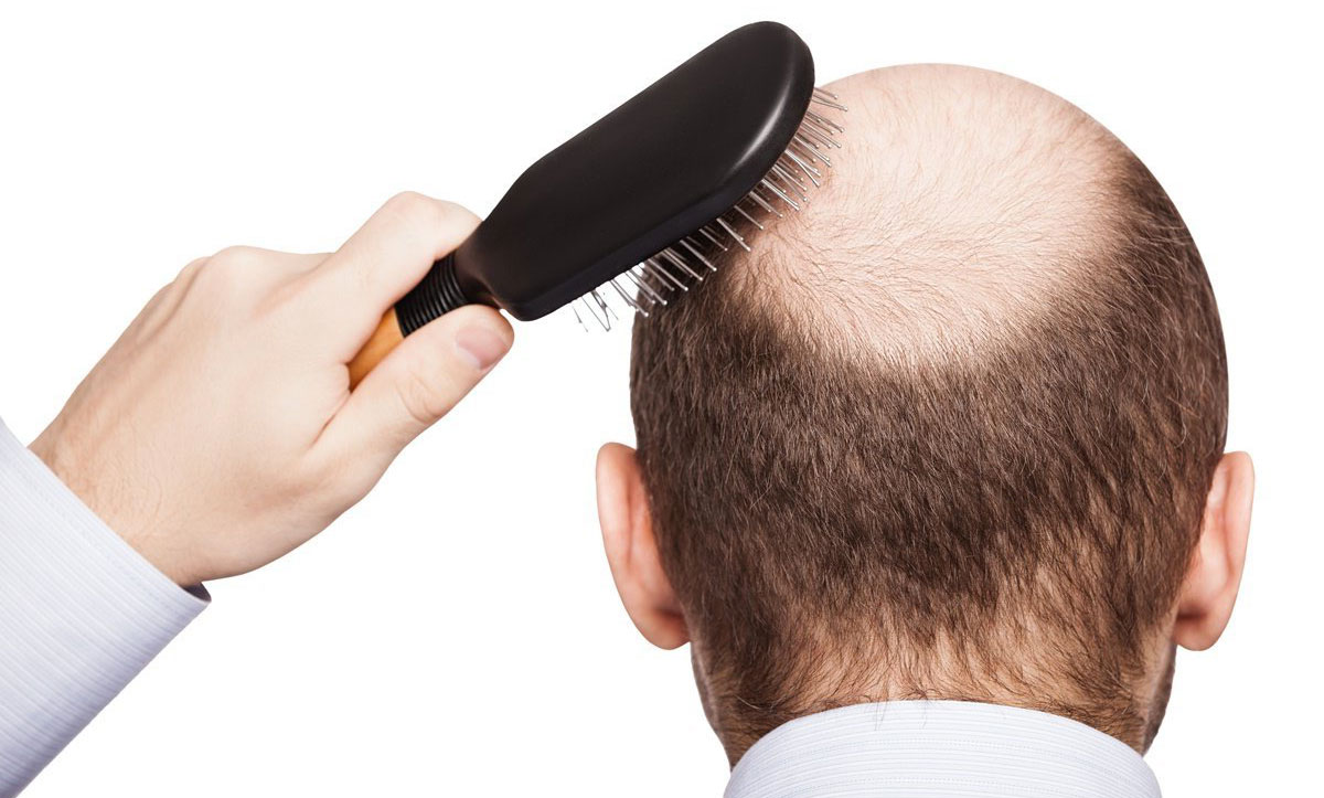 Tóc gãy rụng ở nam có nghiêm trọng không và cách khắc phục tình trạng này -  iCare Pharma