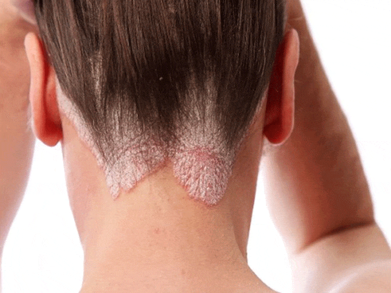 Nấm da đầu có gây rụng tóc không Có làm hói đầu  Sinh Long Đường  Phòng  Khám Chuyên Khoa Y Học Cổ Truyền Sinh Long Đường