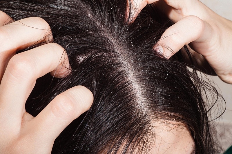 Gàu nấm ảnh hưởng như thế nào đến tóc của bạn?