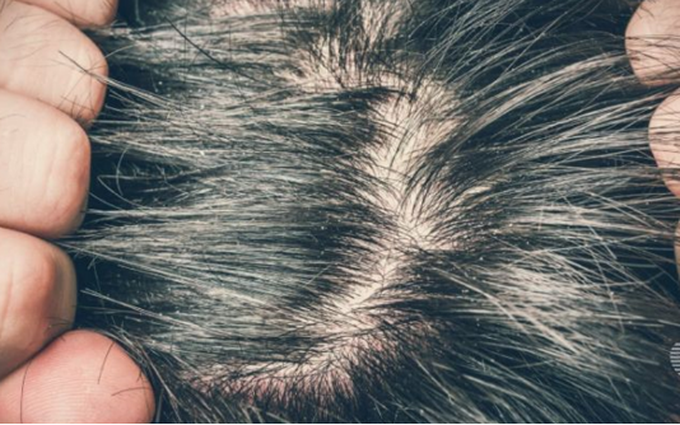 Ngứa da đầu và cách điều trị