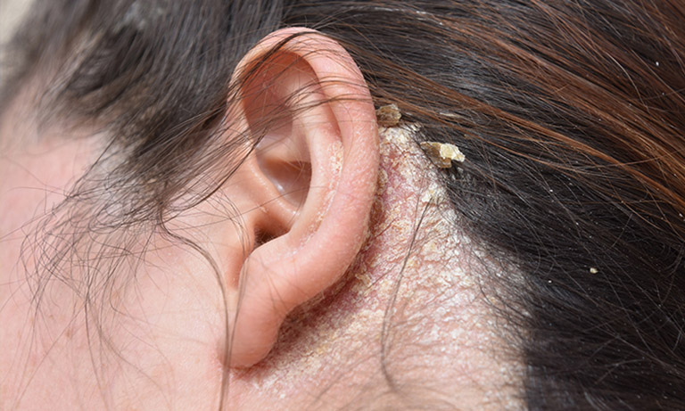 Ngứa da đầu cũng là nguyên nhân gây ra viêm da tiết bã