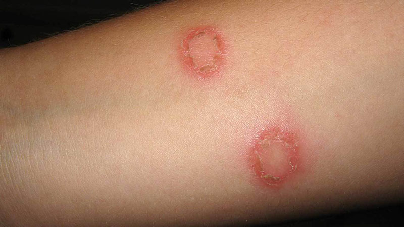 Nhận biết bệnh vảy nến qua các mảng đỏ trên da 