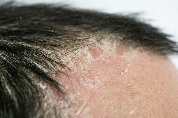 Vẩy nến da đầu tái phát mạnh vào mùa mưa do độ ẩm tăng cao