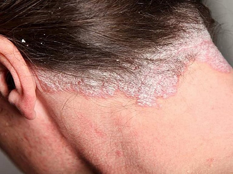 Sự thật về vảy nến da đầu và biểu hiện triệu chứng 