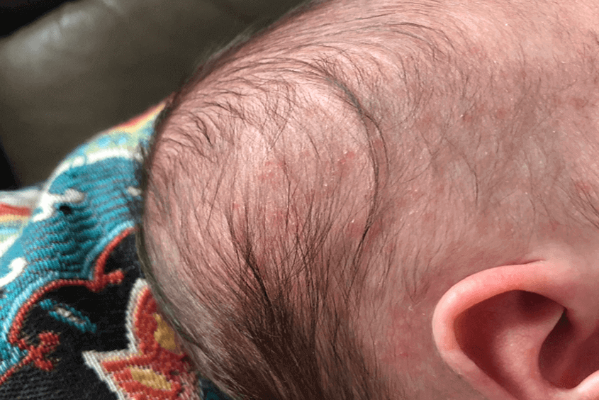 Vẩy nến da đầu ở trẻ em gây đỏ và viêm da 