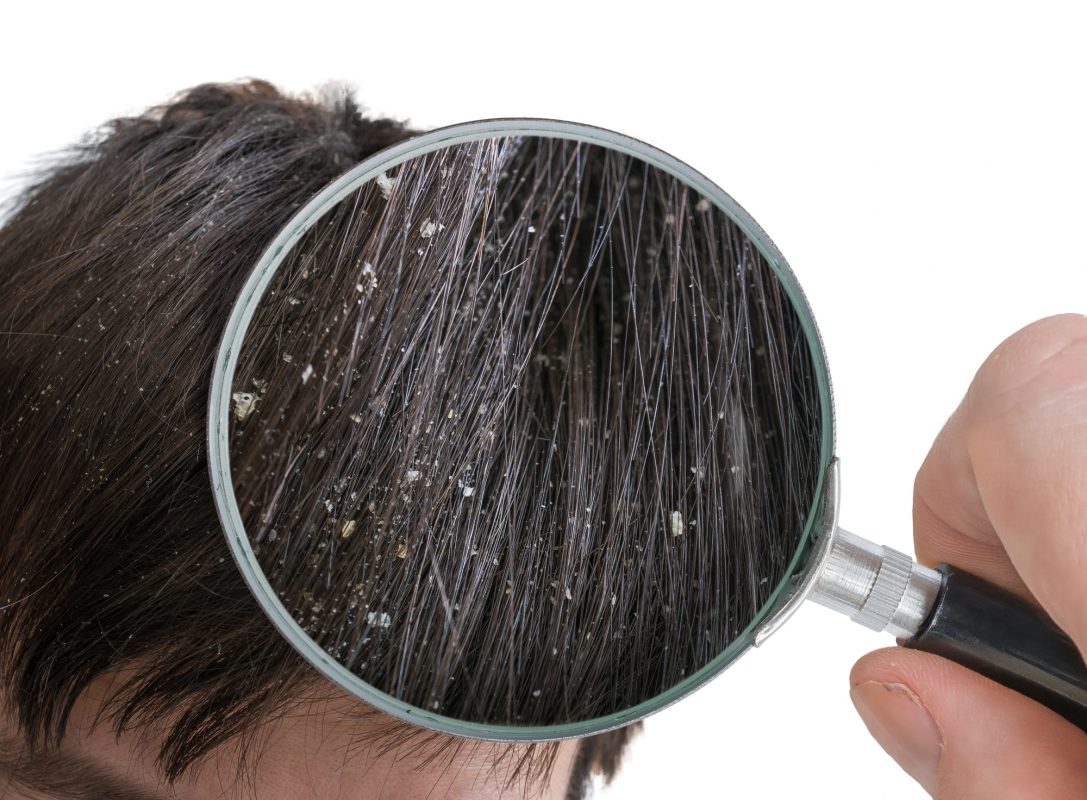 Ngứa da đầu - bệnh lý mãn tính thường xuyên tái phát nếu không chữa trị đúng