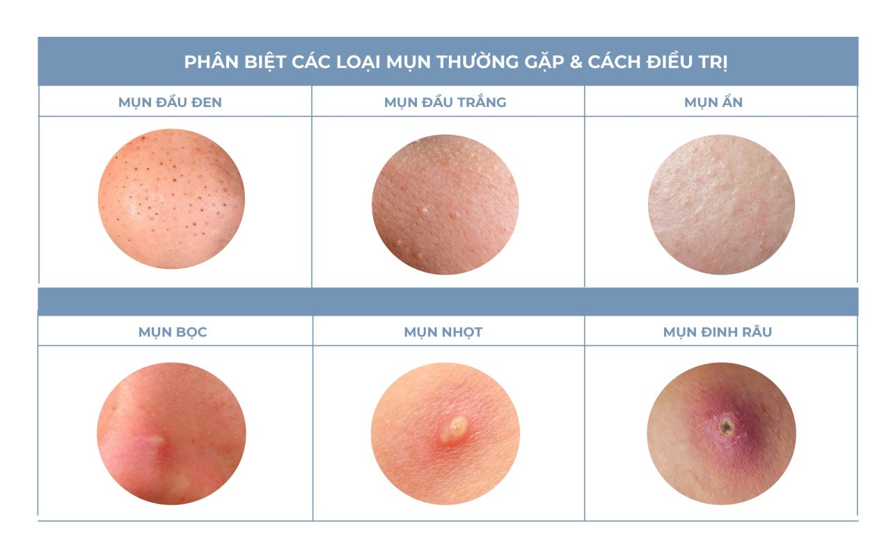 Các loại mụn lưng thường thấy