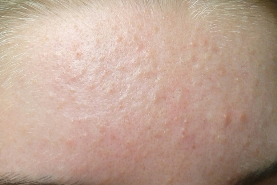 cách trị mụn ẩn