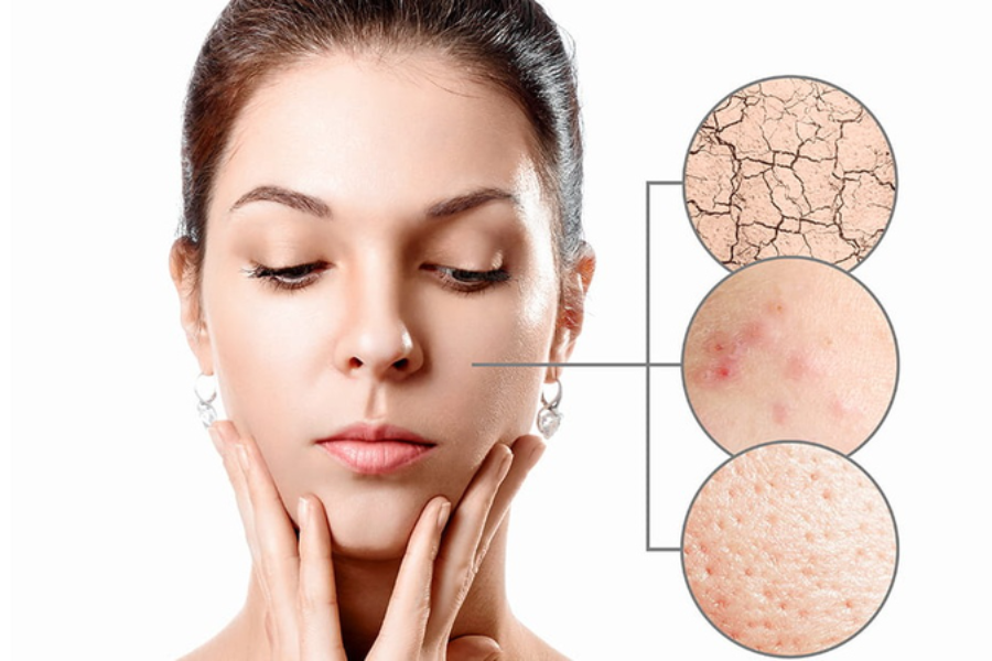 phục hồi da nhiễm corticoid