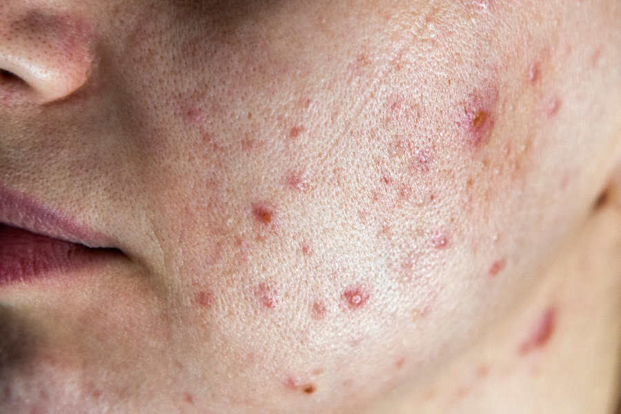 trị mụn trứng cá 