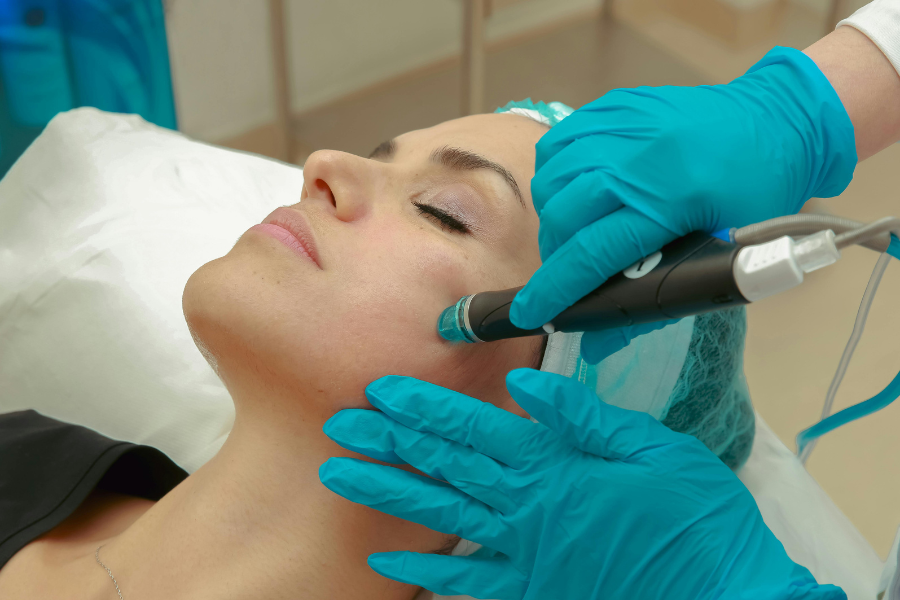 trị nám bằng laser
