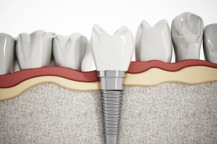trồng răng implant 