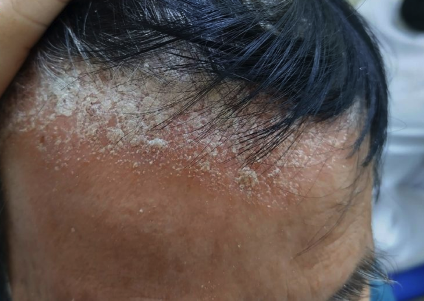 Stress có làm tăng gàu không?