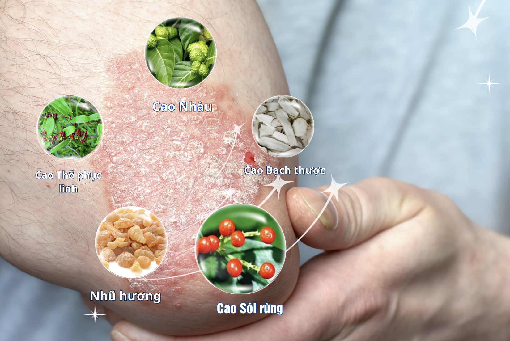 Sự thật về mối quan hệ giữa chế độ ăn uống và vảy nến trên da đầu