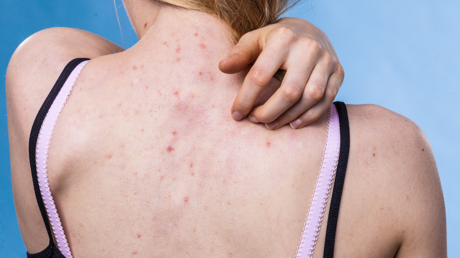 5 sai lầm khi chăm sóc da lưng, mụn, viêm nang lông, chăm sóc da lưng