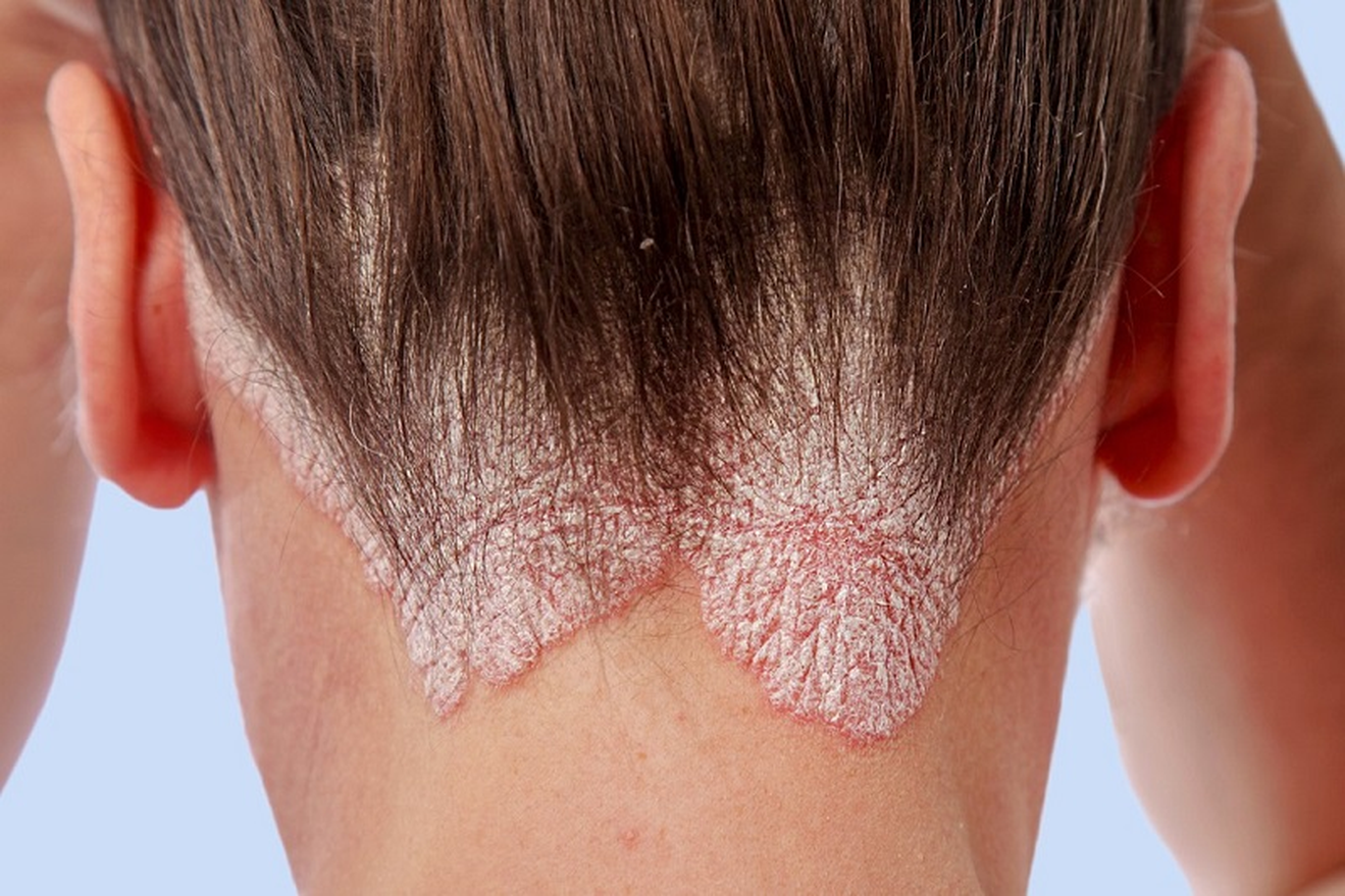 Vảy nến trên da đầu: Nguyên nhân, triệu chứng và cách cải thiện