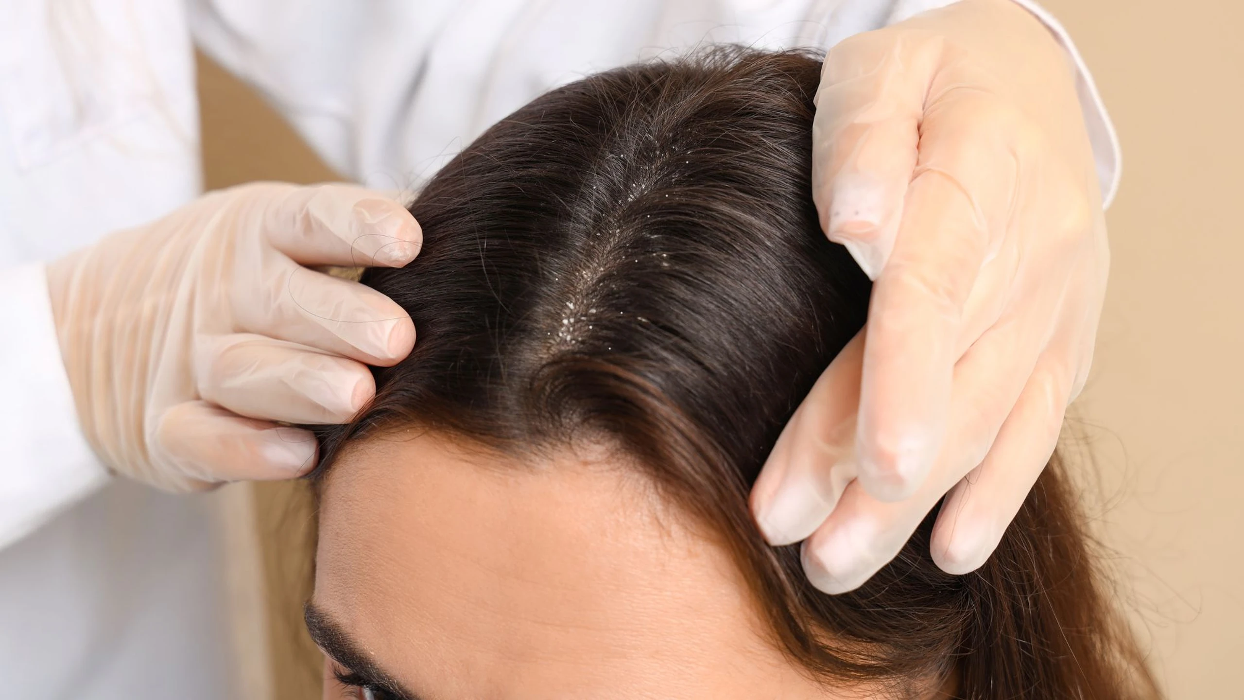 5 bí quyết chăm sóc tóc để giảm ngứa da đầu do vảy nến