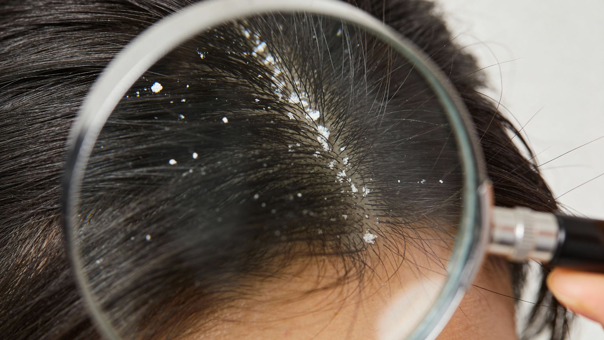 Làm thế nào để nhận biết dấu hiệu đầu tiên của nấm da đầu, điều trị hiệu quả, hỗ trợ cải thiện