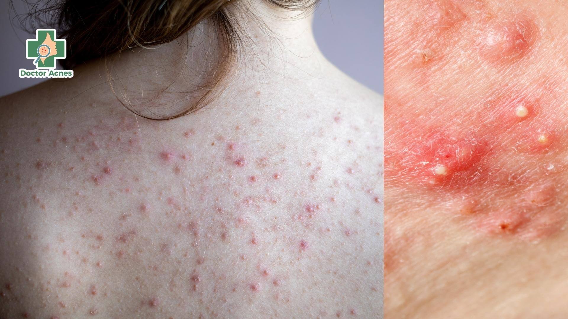 Tại sao mụn lưng hay tái lại