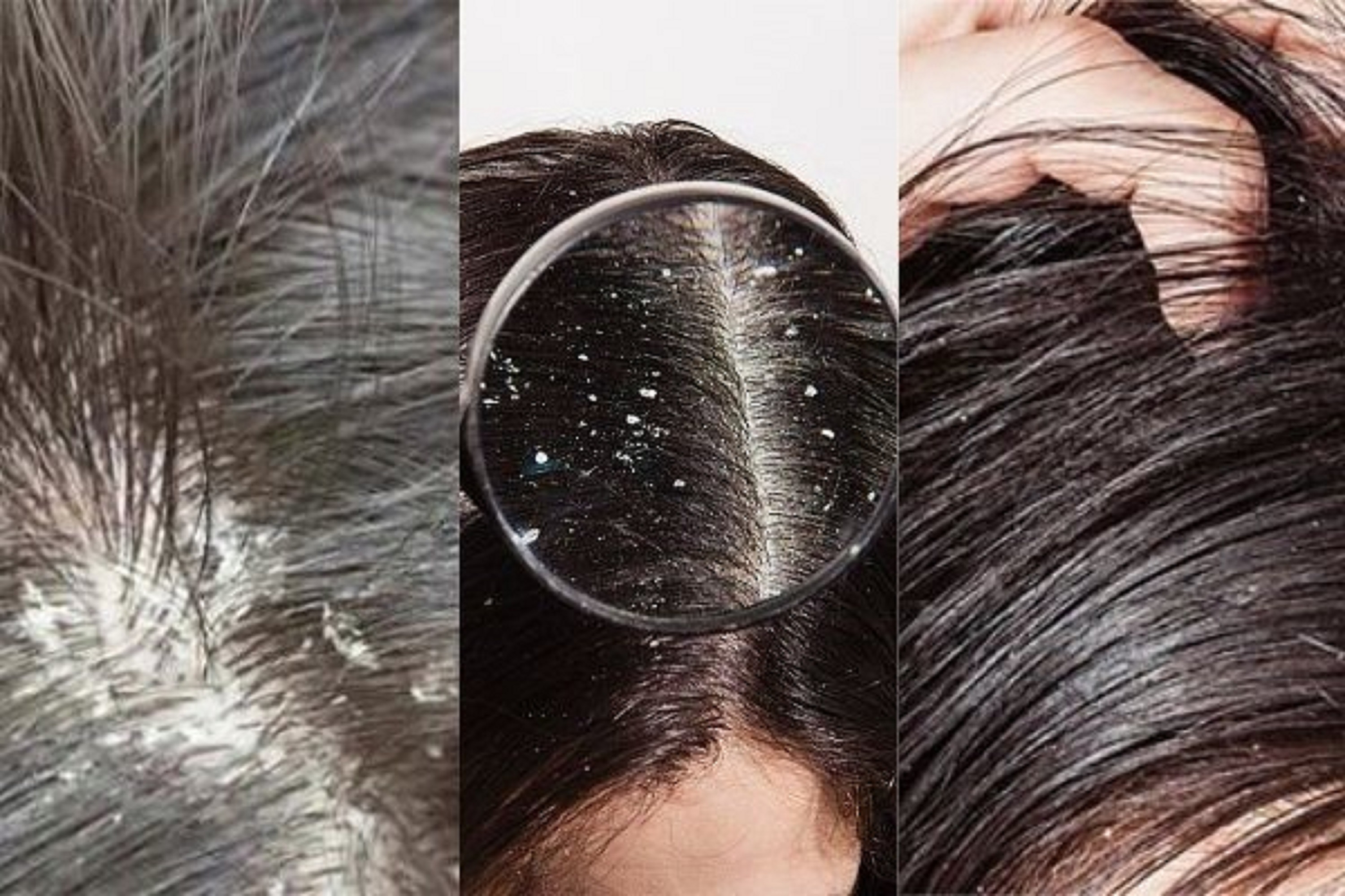 Gàu khô vs gàu dầu: phân biệt đúng để xử lý đúng