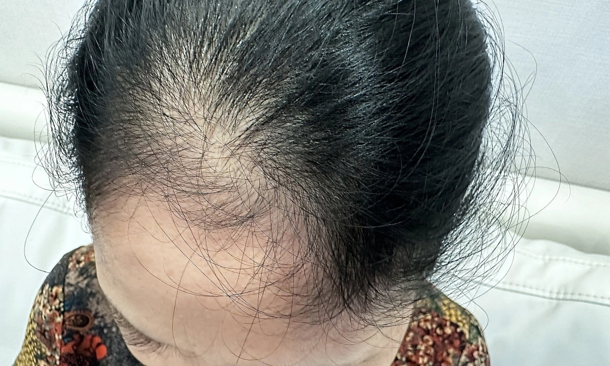Bí quyết tự nhiên giảm ngứa và viêm da đầu do vảy nến