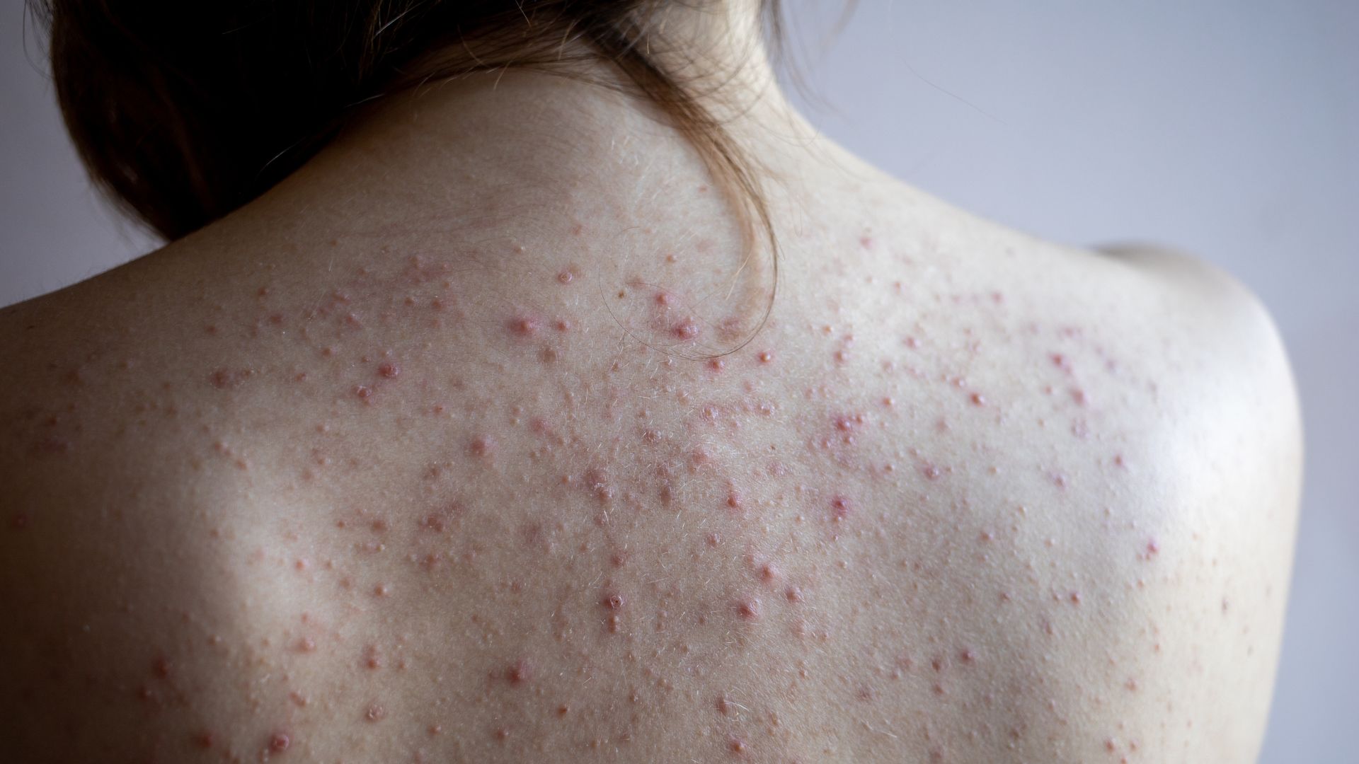 Làm thế nào để loại bỏ mụn lưng một cách hiệu quả