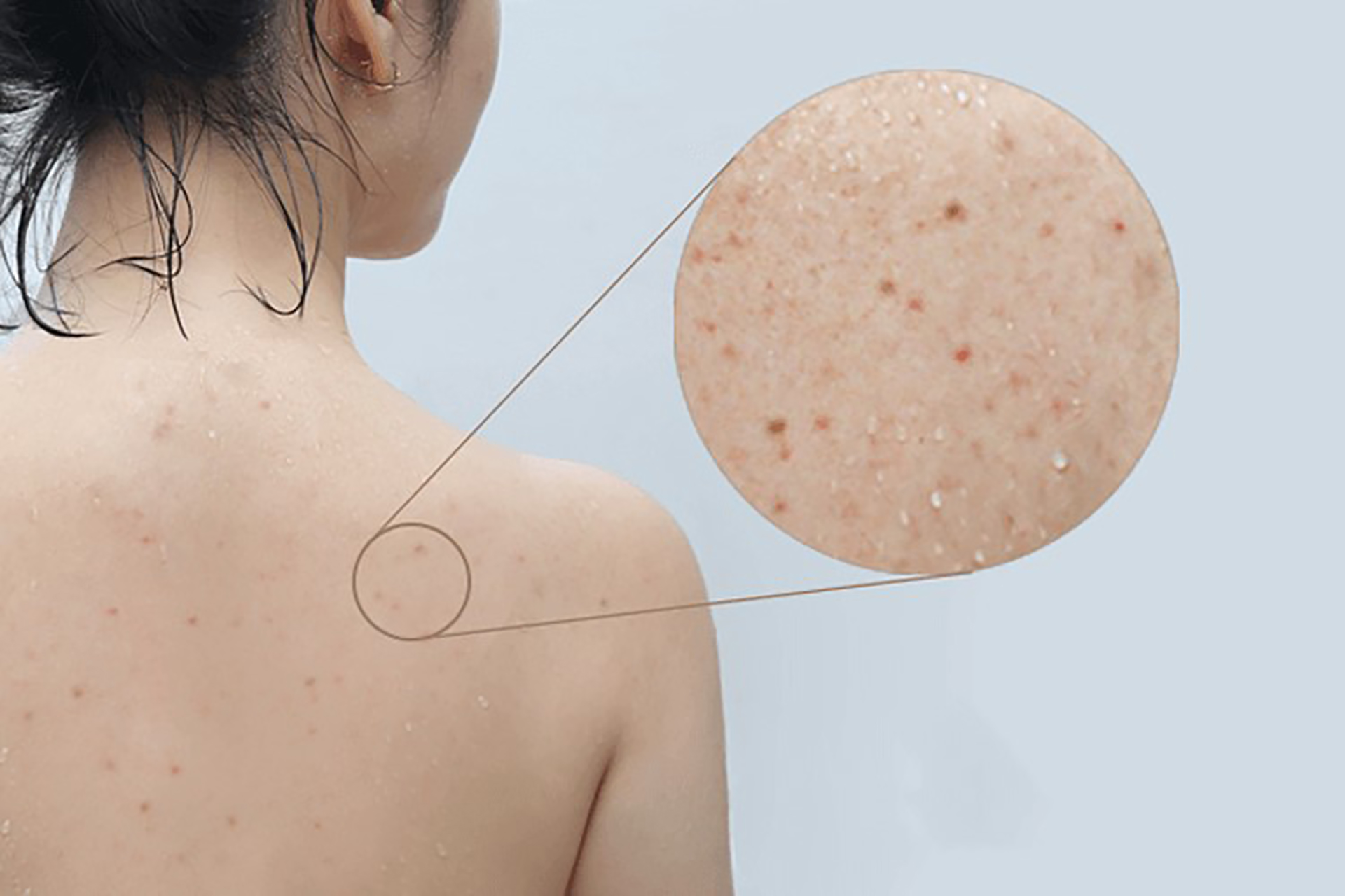 Làm thế nào để loại bỏ mụn lưng một cách hiệu quả