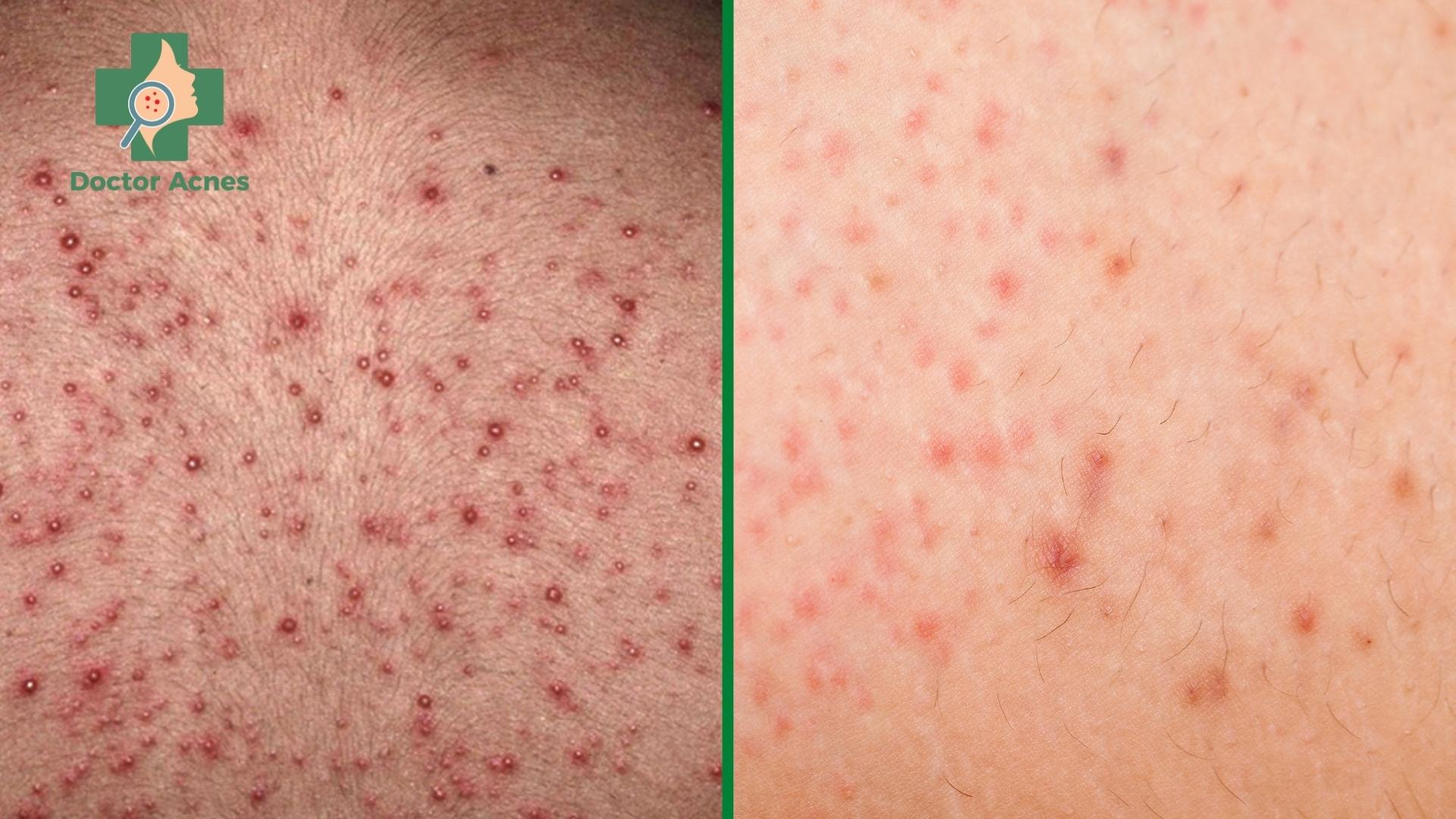 5 sai lầm khi chăm sóc da lưng, mụn, viêm nang lông, chăm sóc da lưng