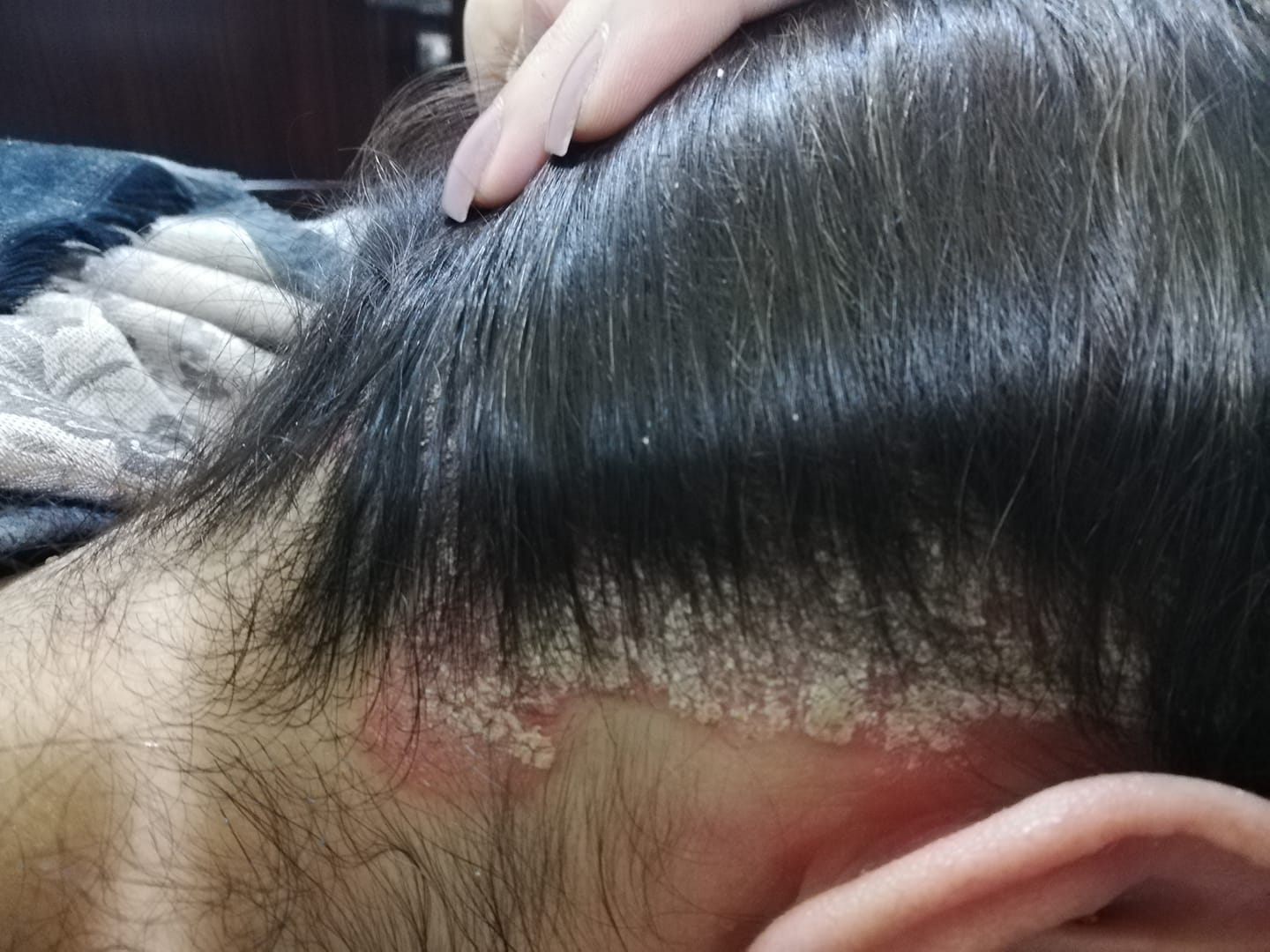 Vì sao nấm hay tái lại dù đã hết, giải pháp chăm sóc nấm, kiểm soát nấm