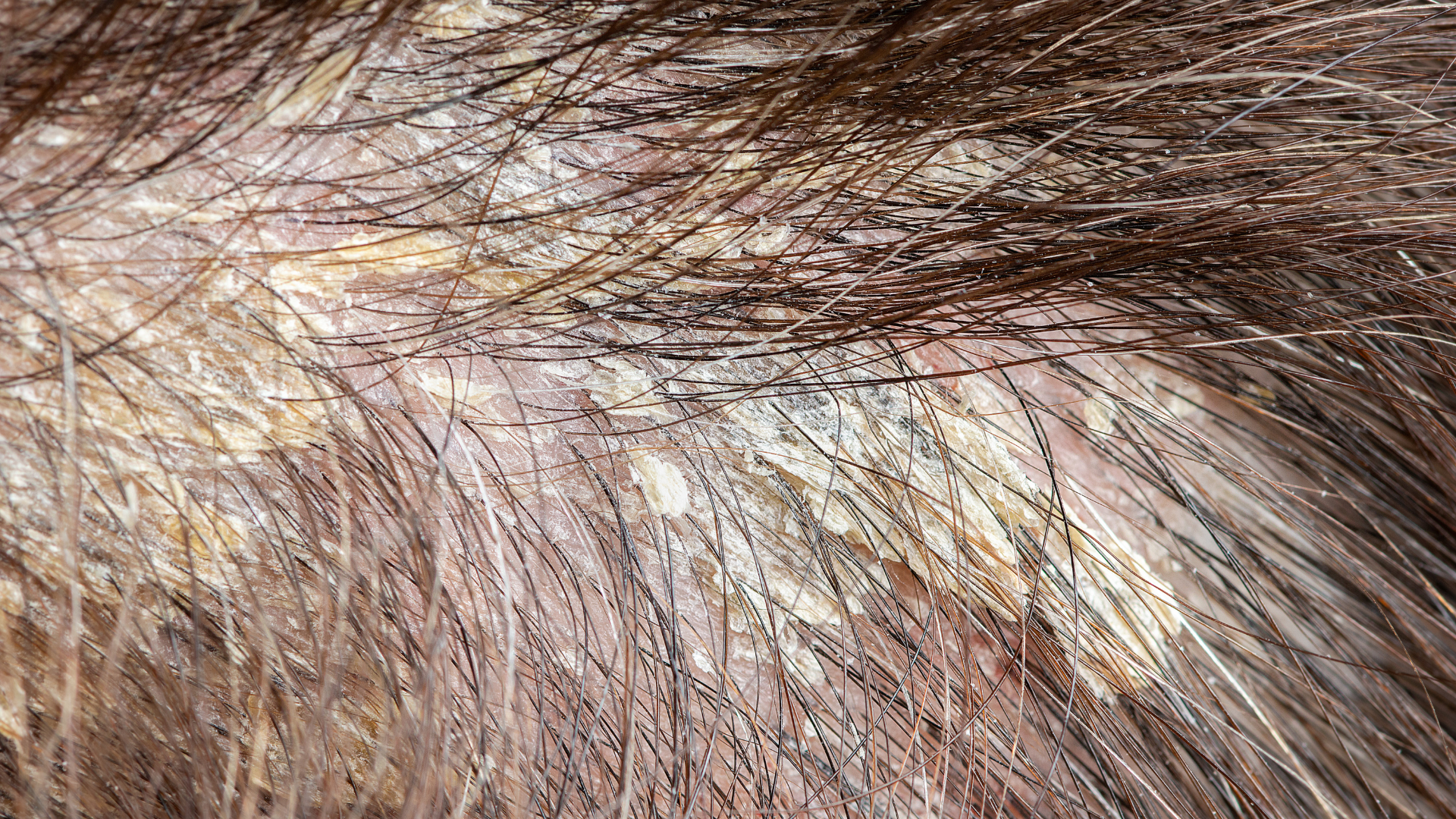 Dấu hiệu nhận biết nấm da đầu giai đoạn sớm, nấm da đầu, chăm sóc da đầu