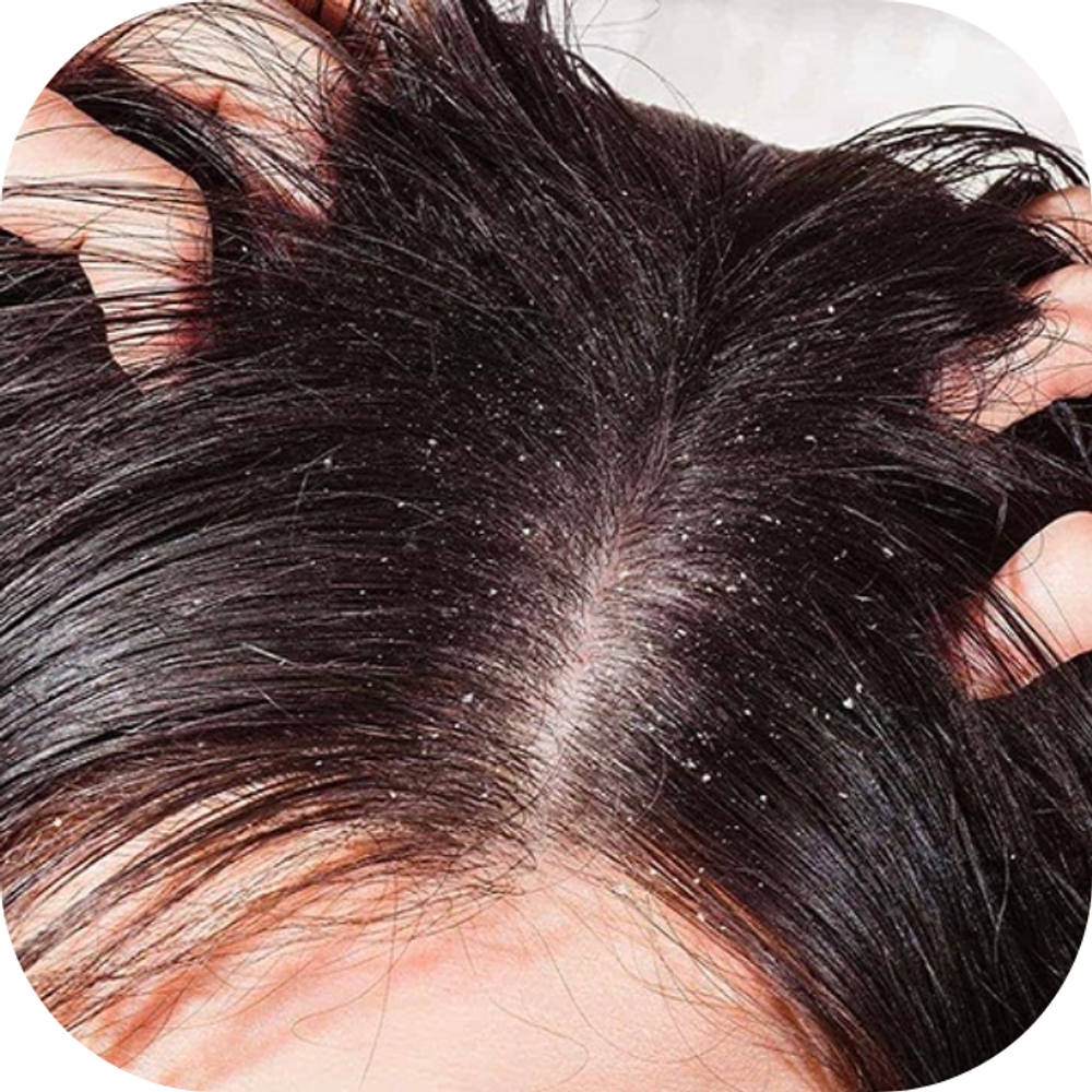 Làm thế nào để nhận biết dấu hiệu đầu tiên của nấm da đầu và điều trị hiệu quả