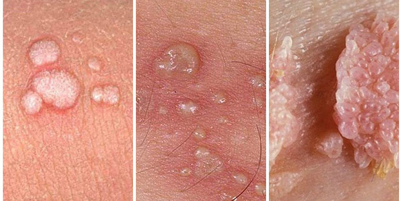 Dấu hiệu hpv ở nữ